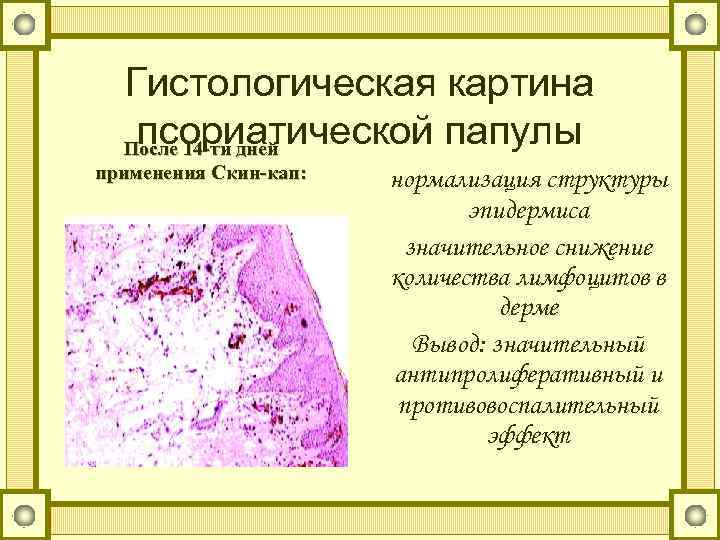 Гистологическая картина псориатической папулы После 14 -ти дней применения Скин-кап: нормализация структуры эпидермиса значительное