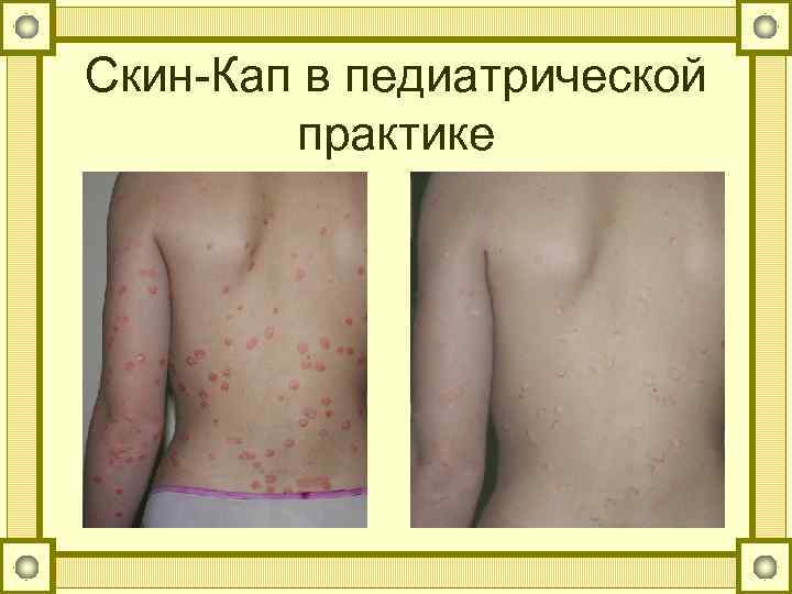 Скин-Кап в педиатрической практике 