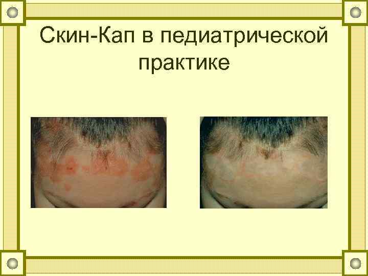 Скин-Кап в педиатрической практике 