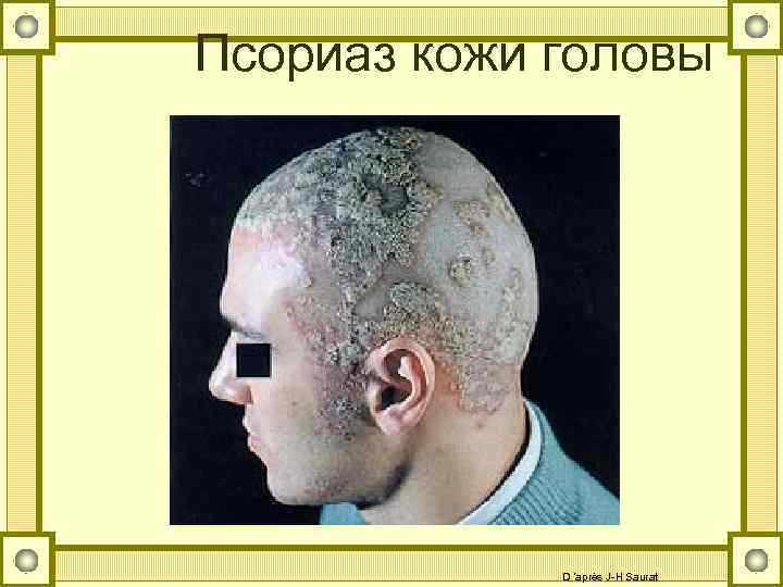 Псориаз кожи головы D ’après J-H Saurat 