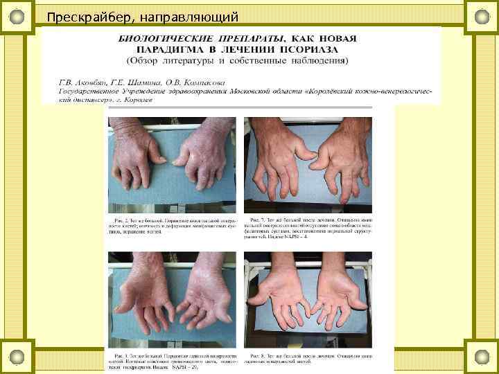 Прескрайбер, направляющий 