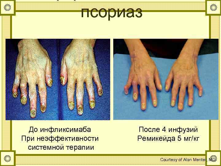 псориаз До инфликсимаба При неэффективности системной терапии После 4 инфузий Ремикейда 5 мг/кг Courtesy