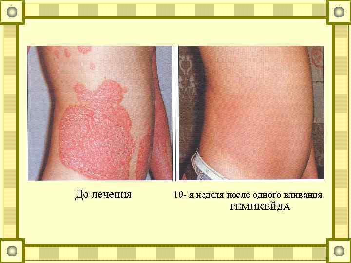 До лечения 10 - я неделя после одного вливания РЕМИКЕЙДА 