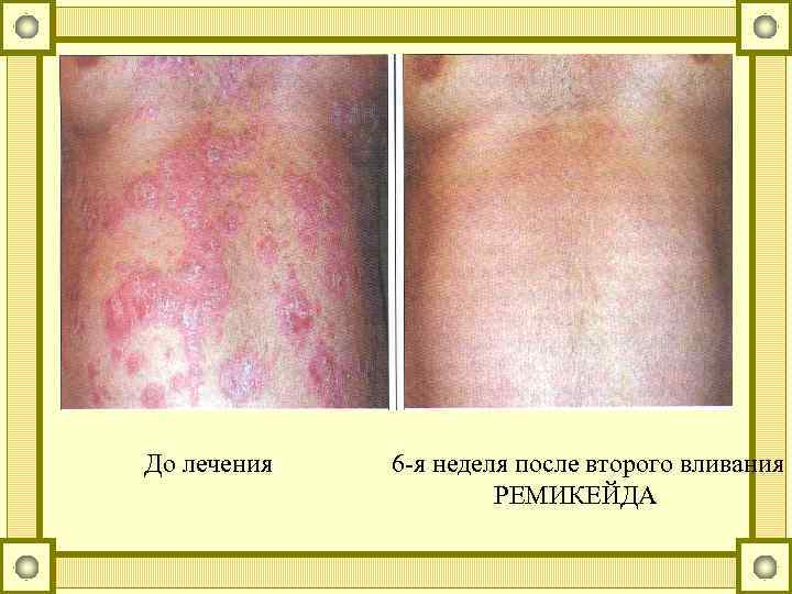 До лечения 6 -я неделя после второго вливания РЕМИКЕЙДА 