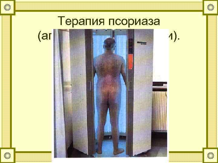 Терапия псориаза (аппарат ПУВА-терапии). 