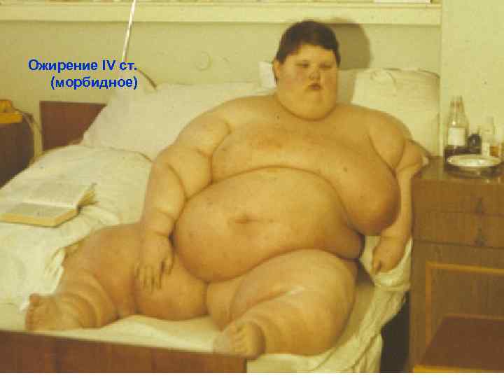 Ожирение IV ст. (морбидное) 