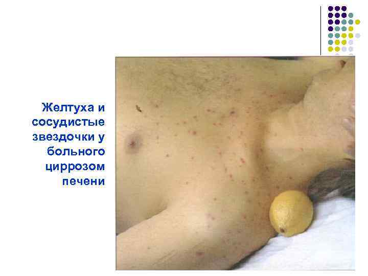 Желтуха и сосудистые звездочки у больного циррозом печени 