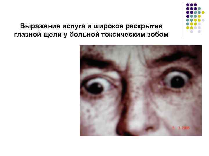 Выражение испуга и широкое раскрытие глазной щели у больной токсическим зобом 