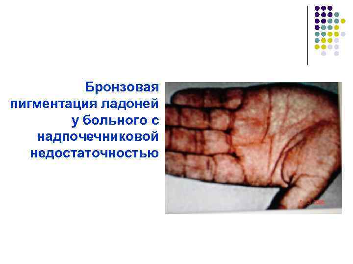 Бронзовая пигментация ладоней у больного с надпочечниковой недостаточностью 