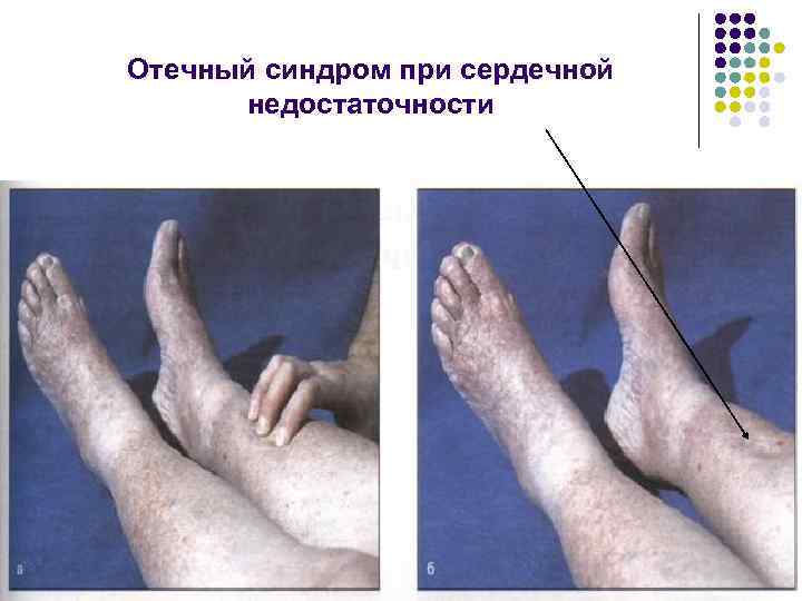 Отечный синдром при сердечной недостаточности 