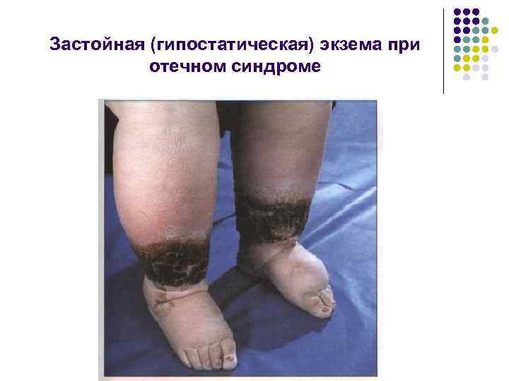 Застойная (гипостатическая) экзема при отечном синдроме 
