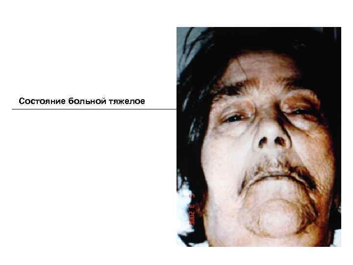 Состояние больной тяжелое 
