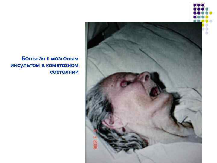 Больная с мозговым инсультом в коматозном состоянии 