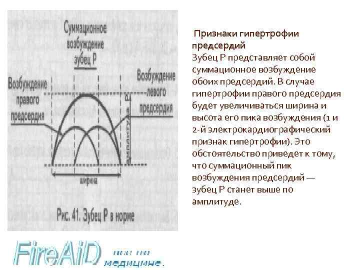  Признаки гипертрофии предсердий Зубец Р представляет собой суммационное возбуждение обоих предсердий. В случае