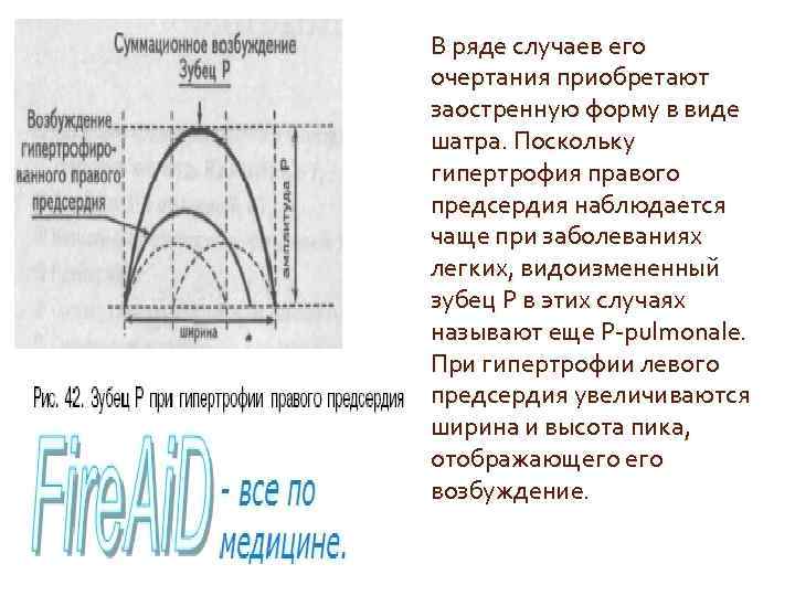 В ряде случаев его очертания приобретают заостренную форму в виде шатра. Поскольку гипертрофия правого