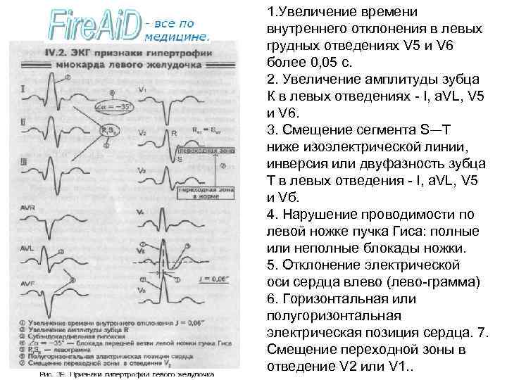 1. Увеличение времени внутреннего отклонения в левых грудных отведениях V 5 и V 6