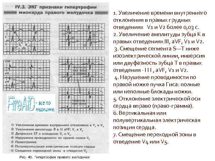 1. Увеличение времени внутреннего отклонения в правых грудных отведениях V 1 и V 2