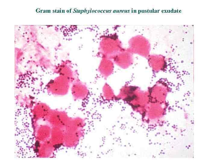 Gram stain of Staphylococcus aureus in pustular exudate 