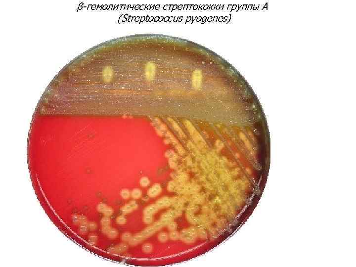 β-гемолитические стрептококки группы А (Streptococcus pyogenes) 