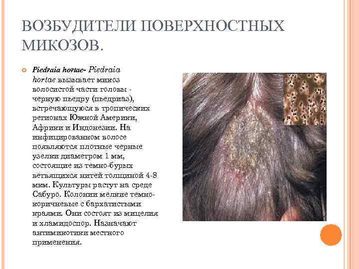 ВОЗБУДИТЕЛИ ПОВЕРХНОСТНЫХ МИКОЗОВ. Piedraia hortae- Piedraia hortae вызывает микоз волосистой части головы черную пьедру