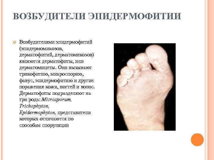 ВОЗБУДИТЕЛИ ЭПИДЕРМОФИТИИ Возбудителями эпидермофитий (эпидермомикозов, дерматофитий, дерматомикозов) являются дерматофиты, или дерматомицеты. Они вызывают трихофитию,