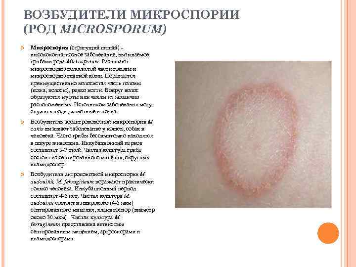 ВОЗБУДИТЕЛИ МИКРОСПОРИИ (РОД MICROSPORUM) Микроспория (стригущий лишай) - высококонтагиозное заболевание, вызываемое грибами рода Microsporum.