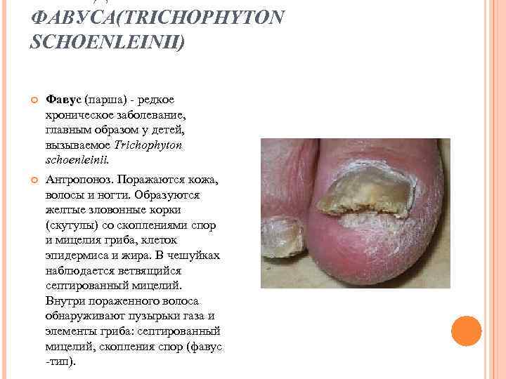 ФАВУСА(TRICHOPHYTON SCHOENLEINII) Фавус (парша) - редкое хроническое заболевание, главным образом у детей, вызываемое Trichophyton