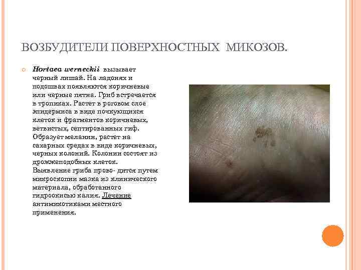 ВОЗБУДИТЕЛИ ПОВЕРХНОСТНЫХ МИКОЗОВ. Hortaea werneckii вызывает черный лишай. На ладонях и подошвах появляются коричневые