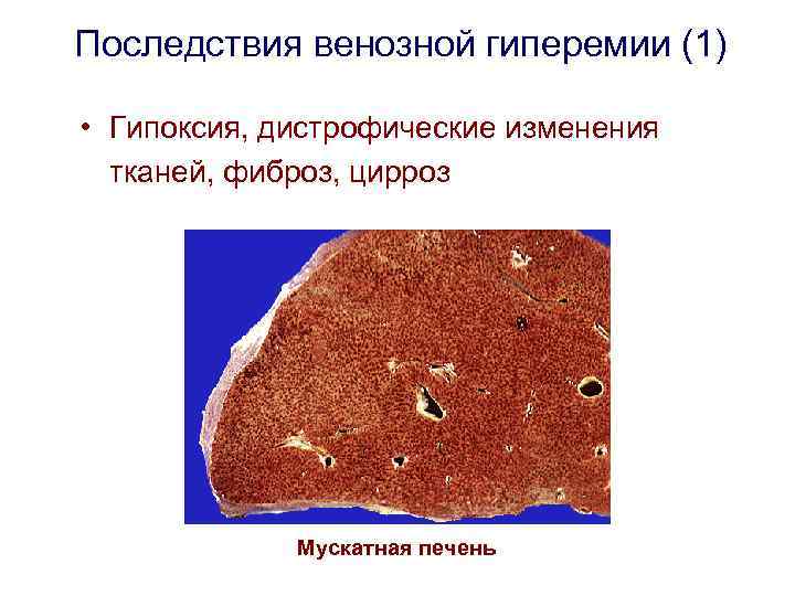 Последствия венозной гиперемии (1) • Гипоксия, дистрофические изменения тканей, фиброз, цирроз Мускатная печень 