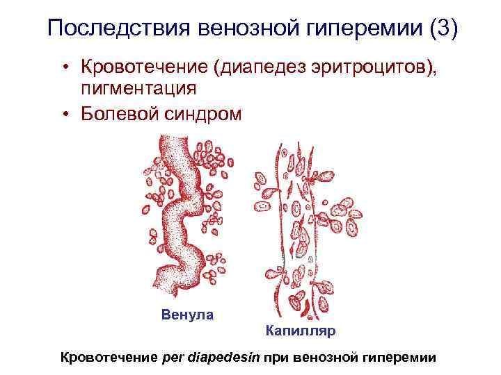 Последствия венозной гиперемии (3) • Кровотечение (диапедез эритроцитов), пигментация • Болевой синдром Венула Капилляр