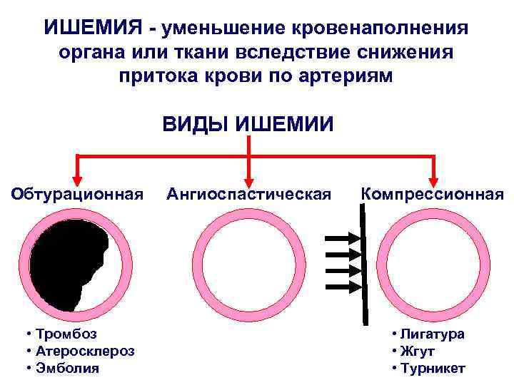 ИШЕМИЯ - уменьшение кровенаполнения органа или ткани вследствие снижения притока крови по артериям ВИДЫ