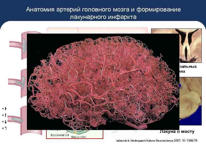 Анатомия артерий головного мозга и формирование лакунарного инфаркта Лакуна в базальных ганглиях • Кровоток