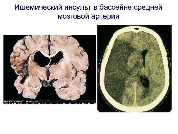 Ишемический инсульт в бассейне средней мозговой артерии 