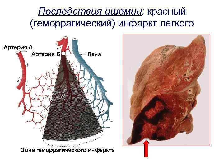 Последствия ишемии: красный (геморрагический) инфаркт легкого Артерия А Артерия Б Вена Зона геморрагического инфаркта