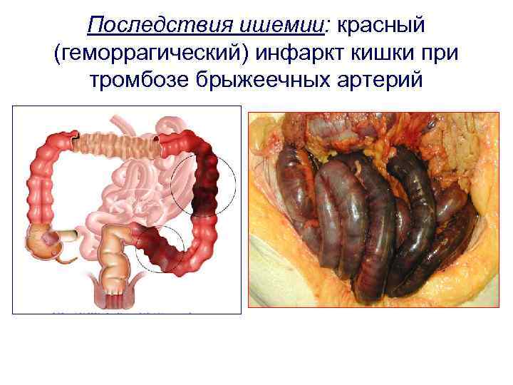 Последствия ишемии: красный (геморрагический) инфаркт кишки при тромбозе брыжеечных артерий 