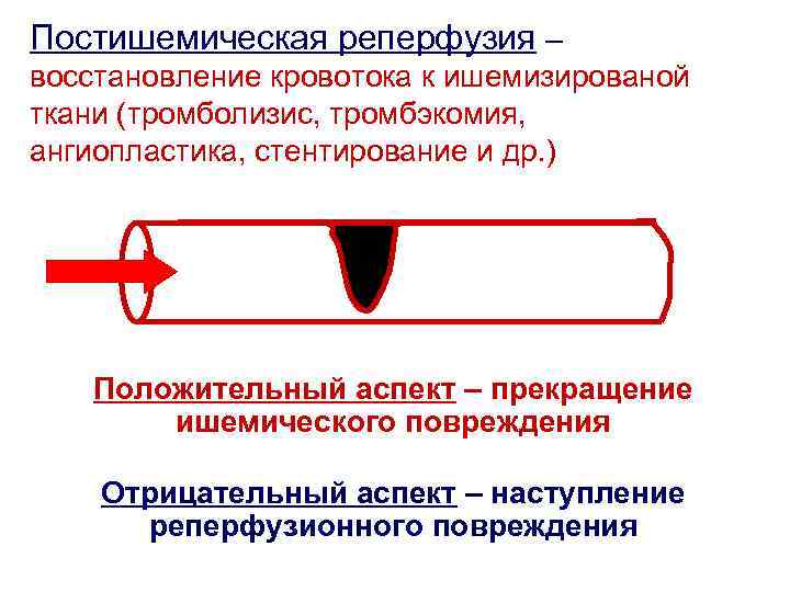 Постишемическая реперфузия – восстановление кровотока к ишемизированой ткани (тромболизис, тромбэкомия, ангиопластика, стентирование и др.