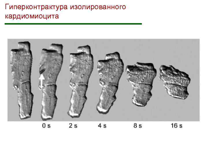 Гиперконтрактура изолированного кардиомиоцита 