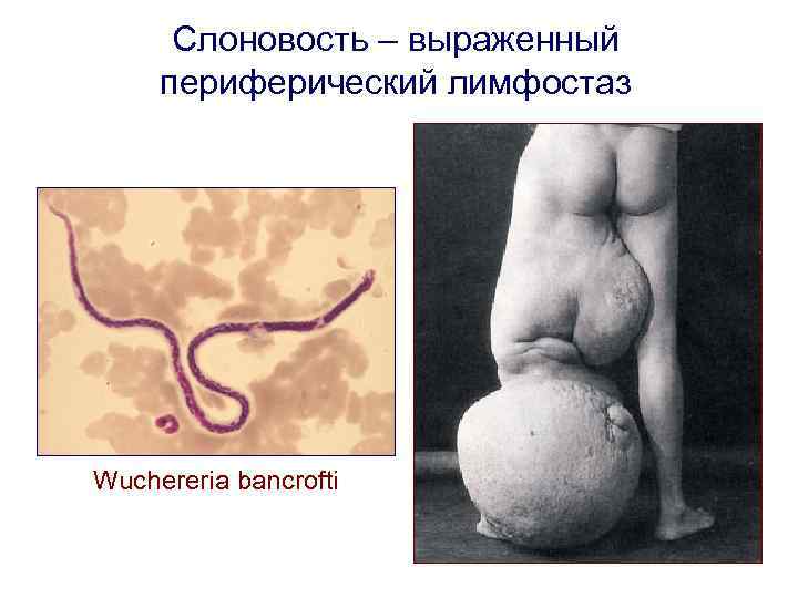 Слоновость – выраженный периферический лимфостаз Wuchereria bancrofti 