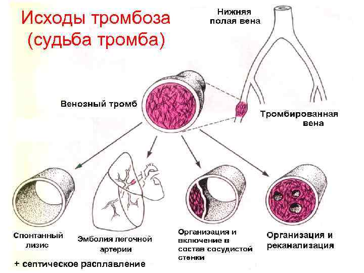 Исходы тромбоза (судьба тромба) + септическое расплавление 