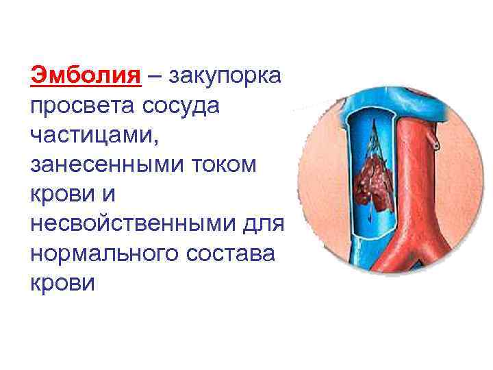 Эмболия – закупорка просвета сосуда частицами, занесенными током крови и несвойственными для нормального состава