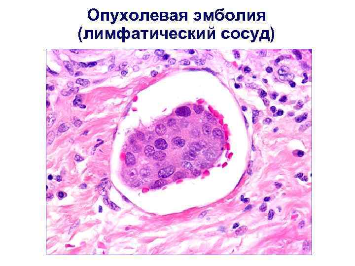 Опухолевая эмболия (лимфатический сосуд) 