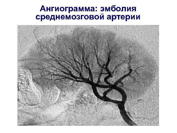 Ангиограмма: эмболия среднемозговой артерии 