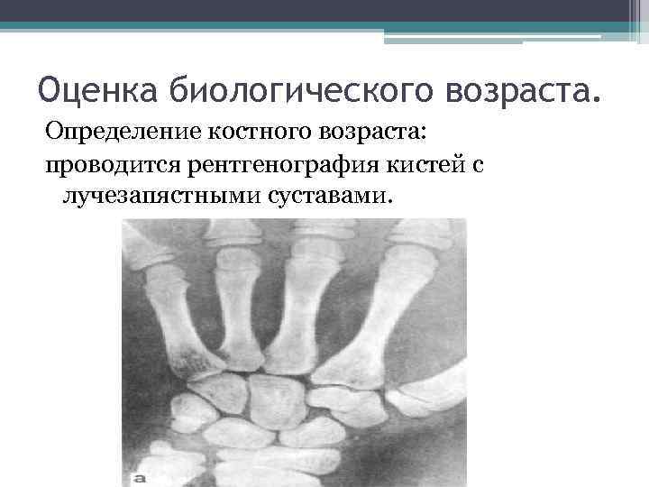 Оценка биологического возраста. Определение костного возраста: проводится рентгенография кистей с лучезапястными суставами. 