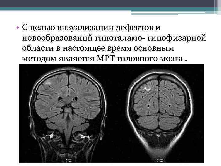  • С целью визуализации дефектов и новообразований гипоталамо- гипофизарной области в настоящее время
