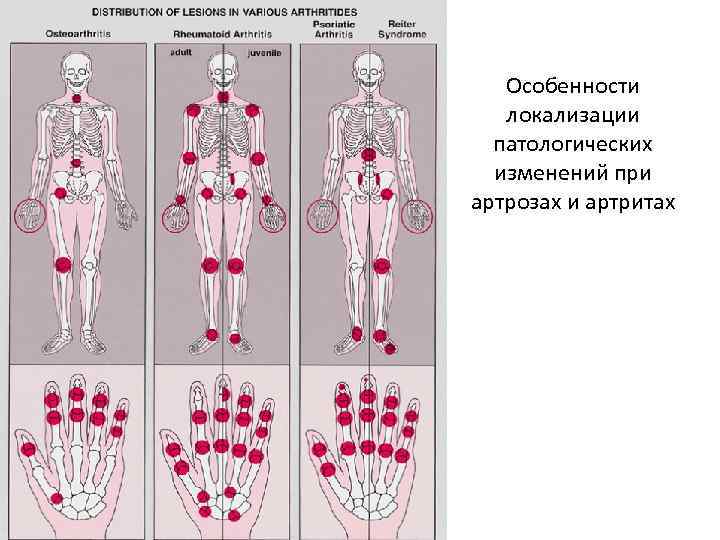 Для клинической картины артроза является характерным