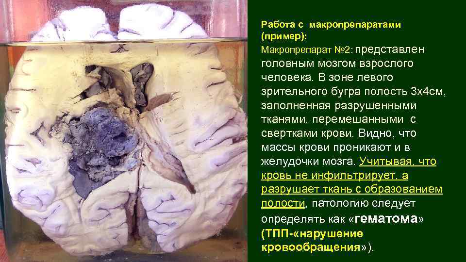 Работа с макропрепаратами (пример): Макропрепарат № 2: представлен головным мозгом взрослого человека. В зоне