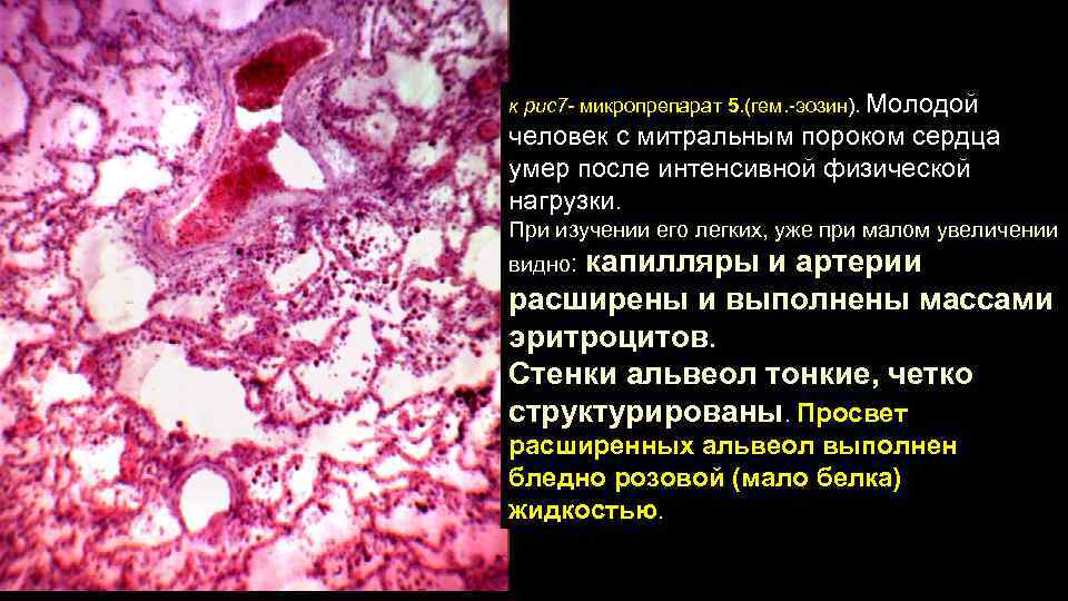 к рис7 - микропрепарат 5. (гем. -эозин). Молодой человек с митральным пороком сердца умер