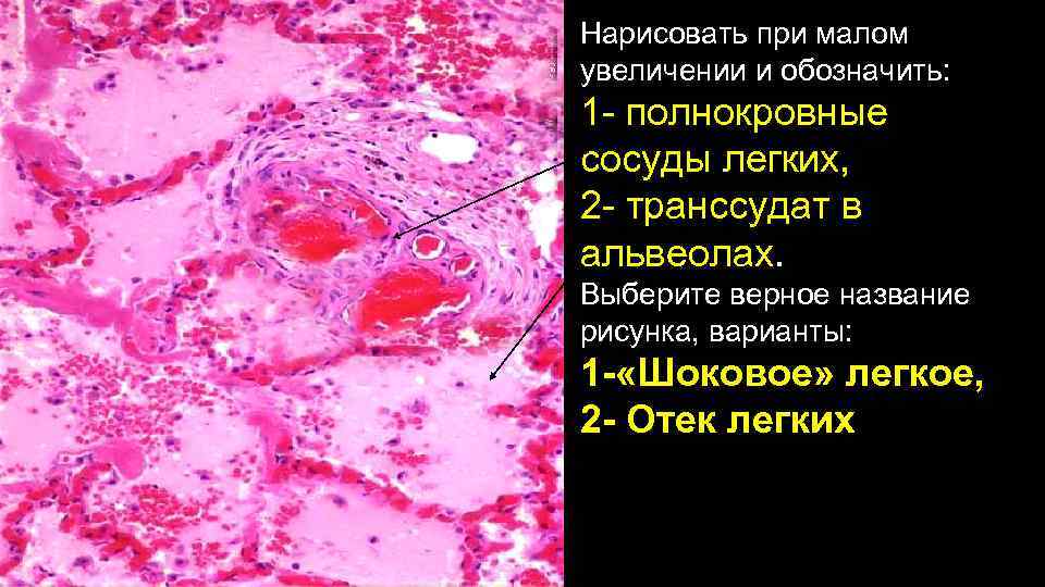 Нарисовать при малом увеличении и обозначить: 1 - полнокровные сосуды легких, 2 - транссудат