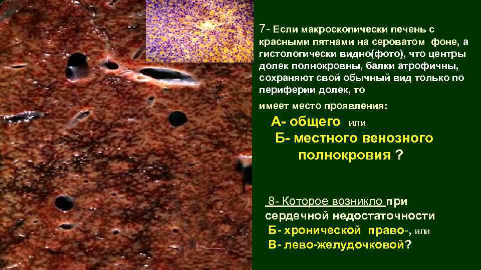 7 - Если макроскопически печень с красными пятнами на сероватом фоне, а гистологически видно(фото),