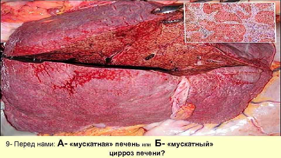 9 - Перед нами: А- «мускатная» печень или Б- «мускатный» цирроз печени? 